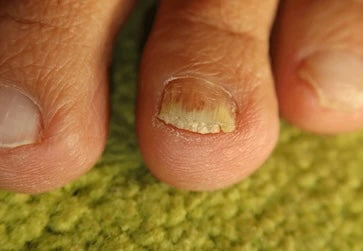 Antifungal Treatment 
